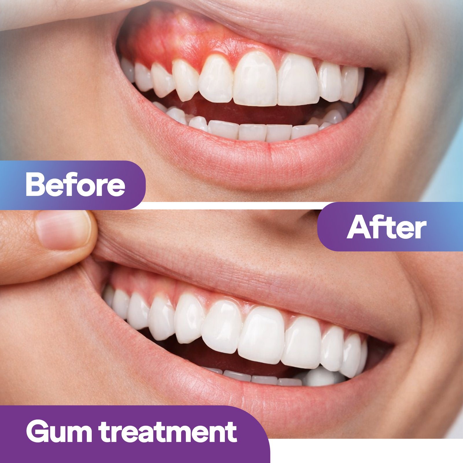 Gum Treatment in Dubai