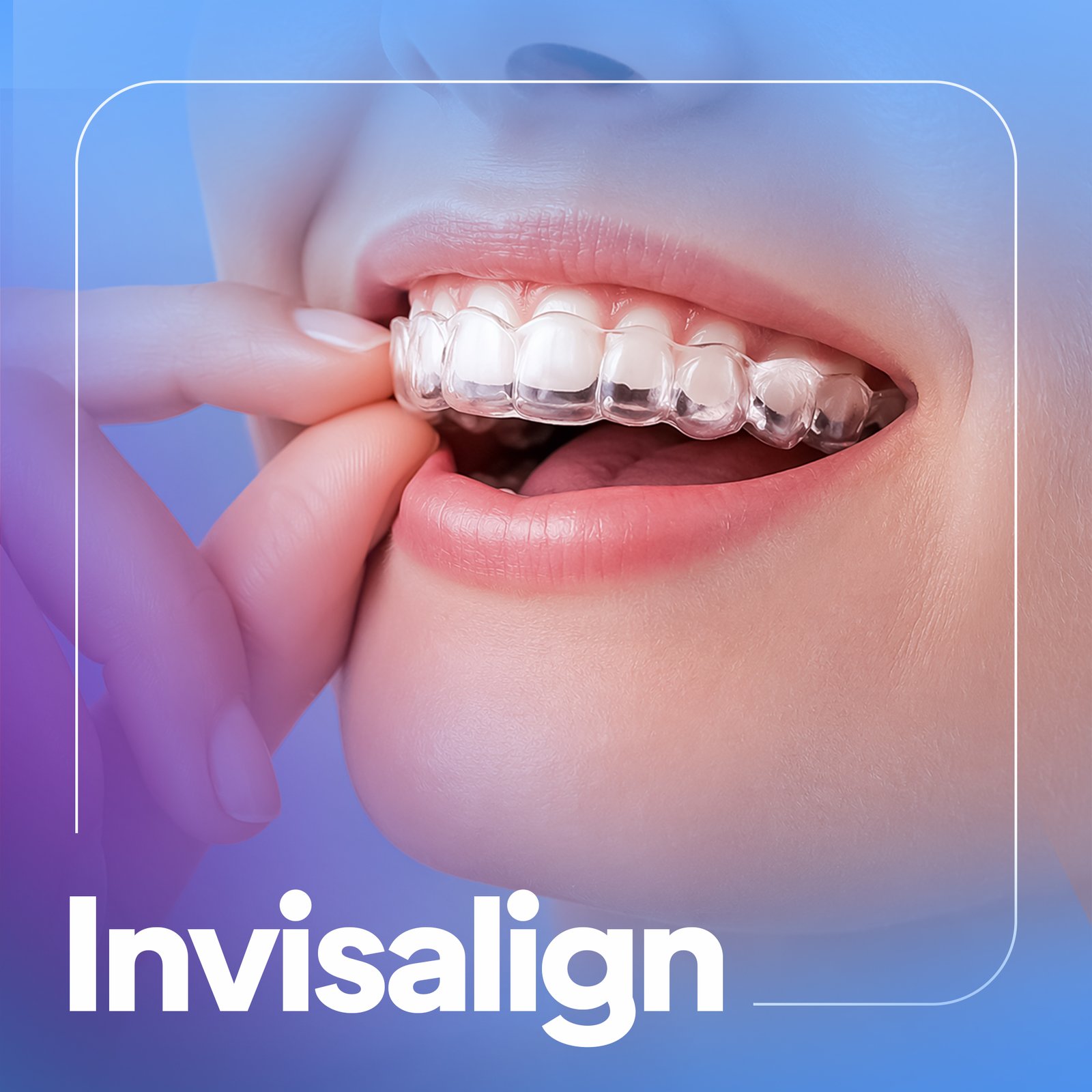 Invisalign in Dubai