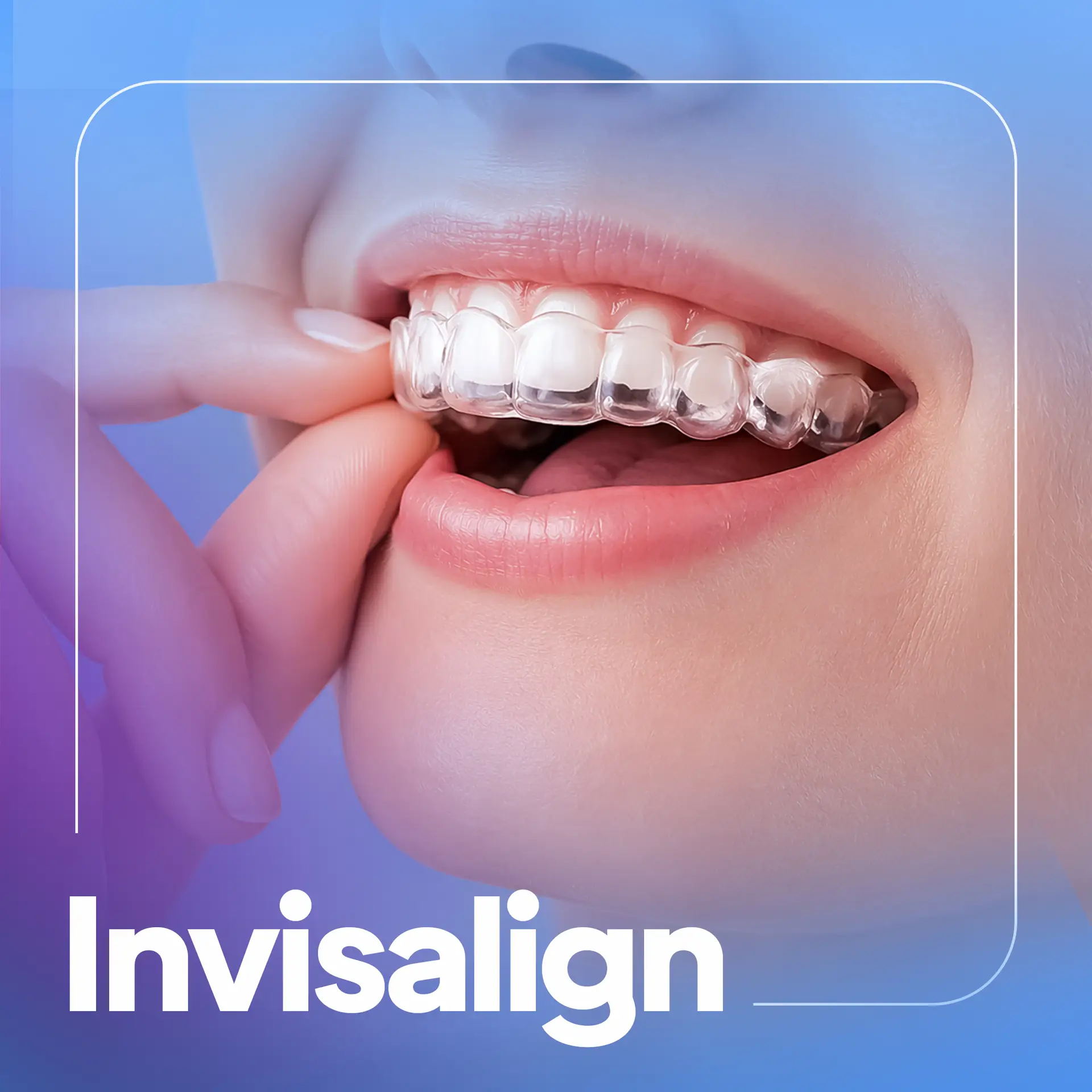 Invisalign in Dubai