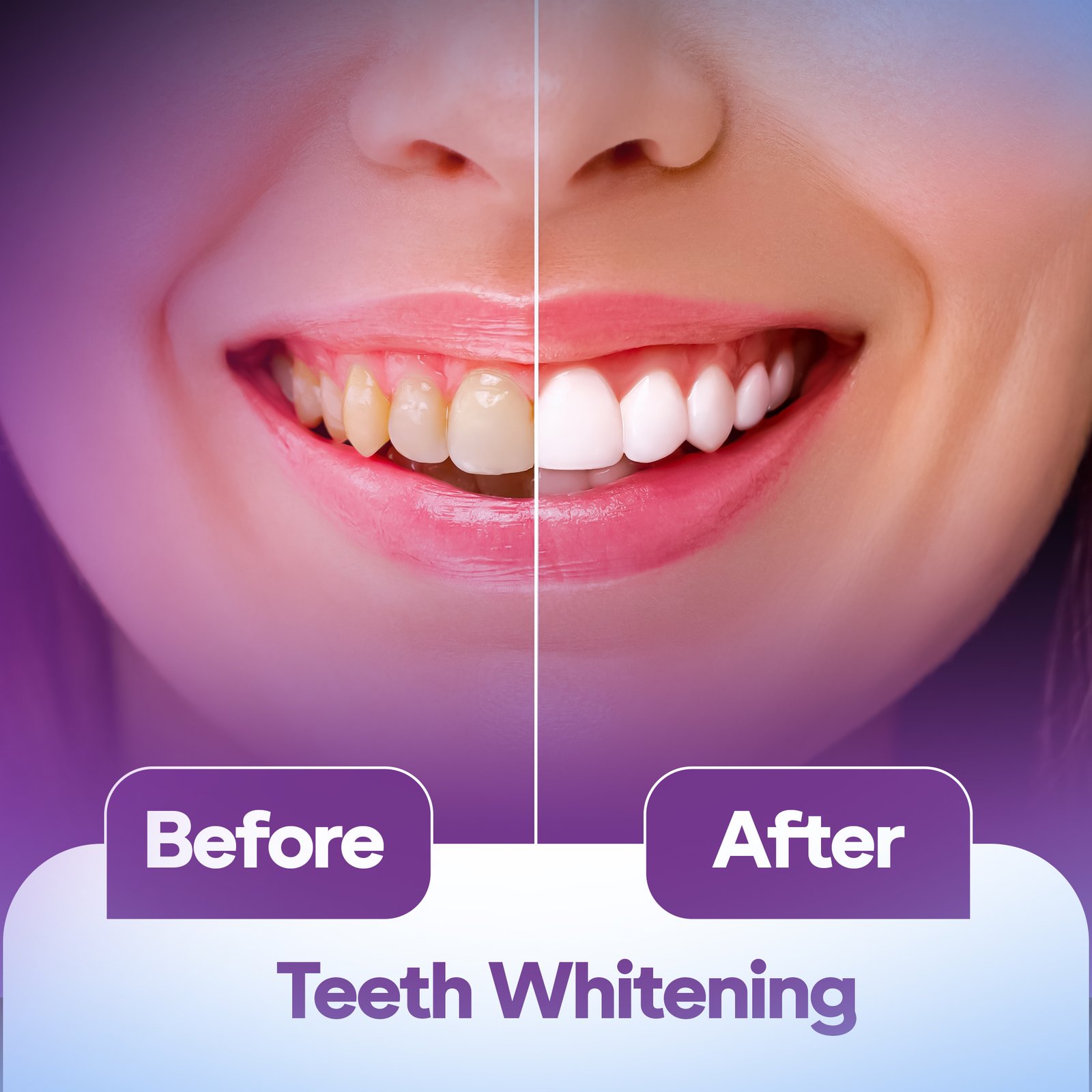 TEETH WHITENING In Dubai