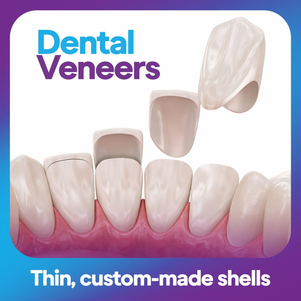 Dental Veneers in Dubai