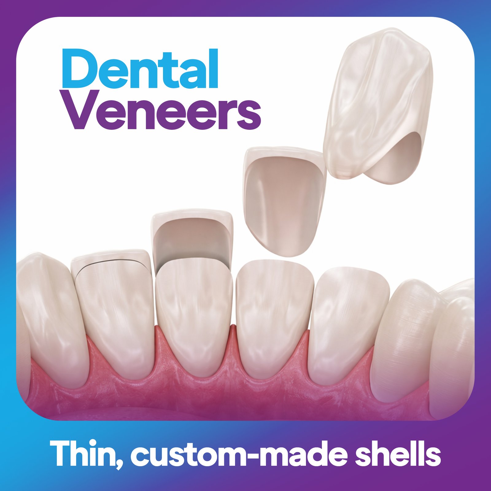 Dental Veneers in Dubai