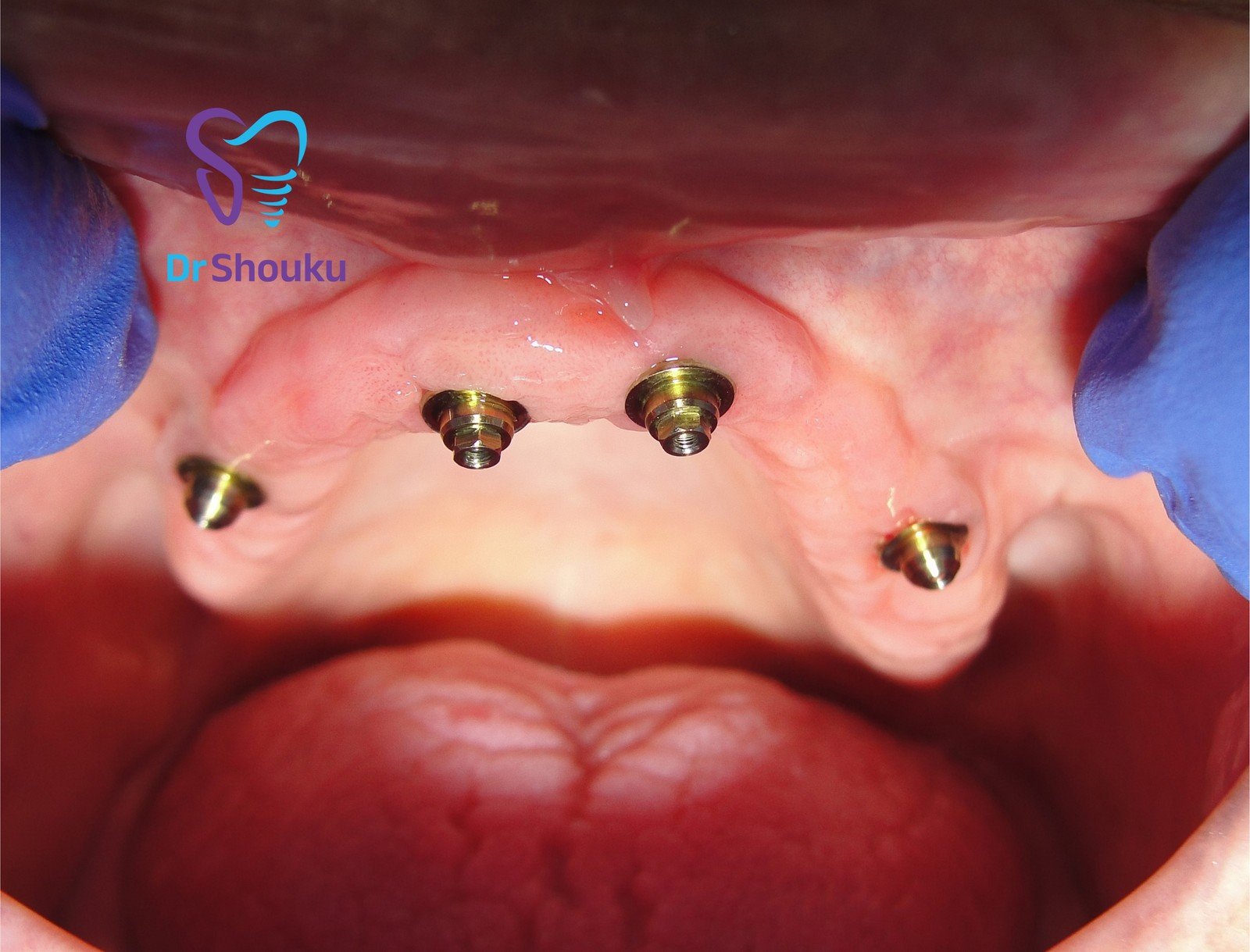 Four implant positions in a clinic All-on-4 case at Dr. Shouku Dental Clinic