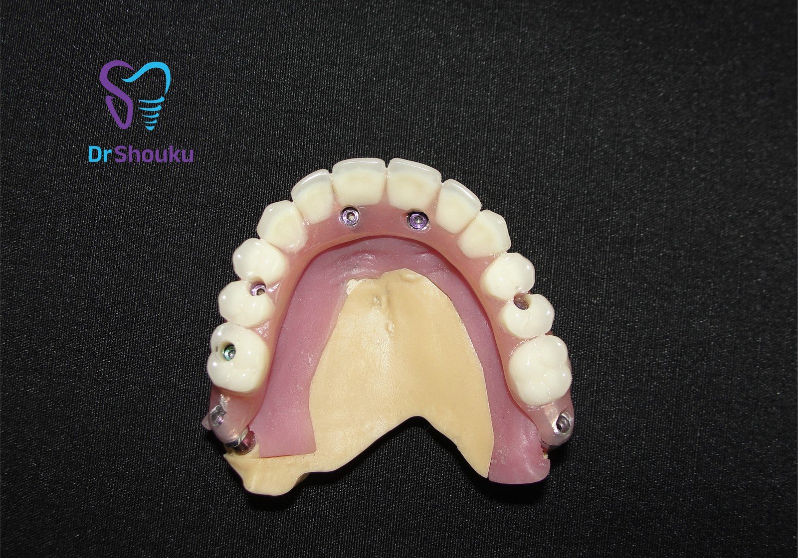 Restoration from an All-on-X case with pterygoid implants at Dr. Shouku Dental Clinic