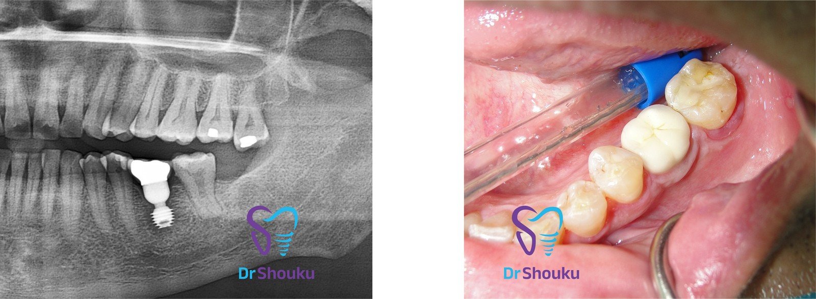 Clinical photograph and X-ray from a Bicon short implant case at Dr. Shouku Dental Clinic