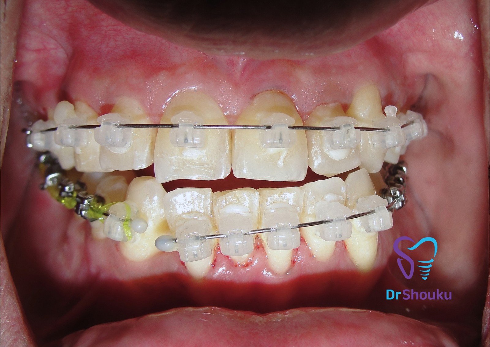 Tooth-coloured ceramic brackets fitted to teeth at Dr. Shouku Dental Clinic