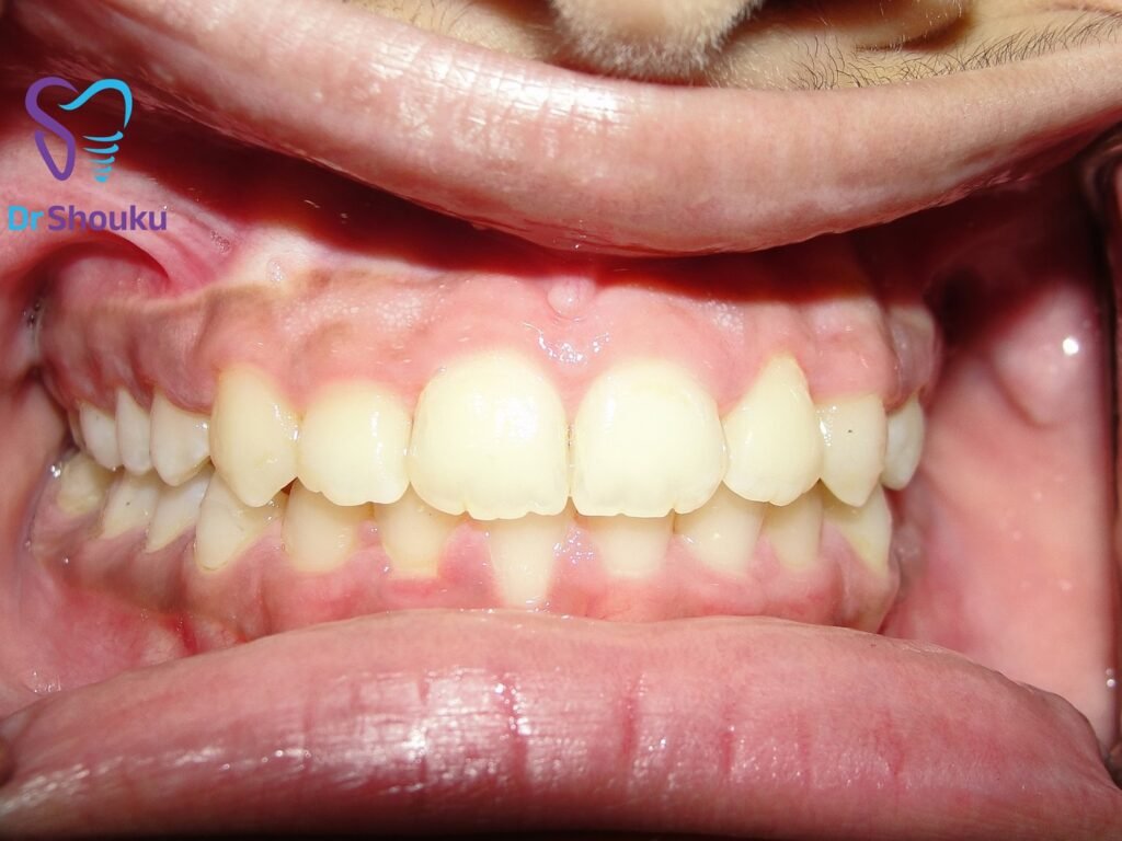 crossbite correction fixed braces — after 03, case 18 at Dr. Shouku Dental Clinic