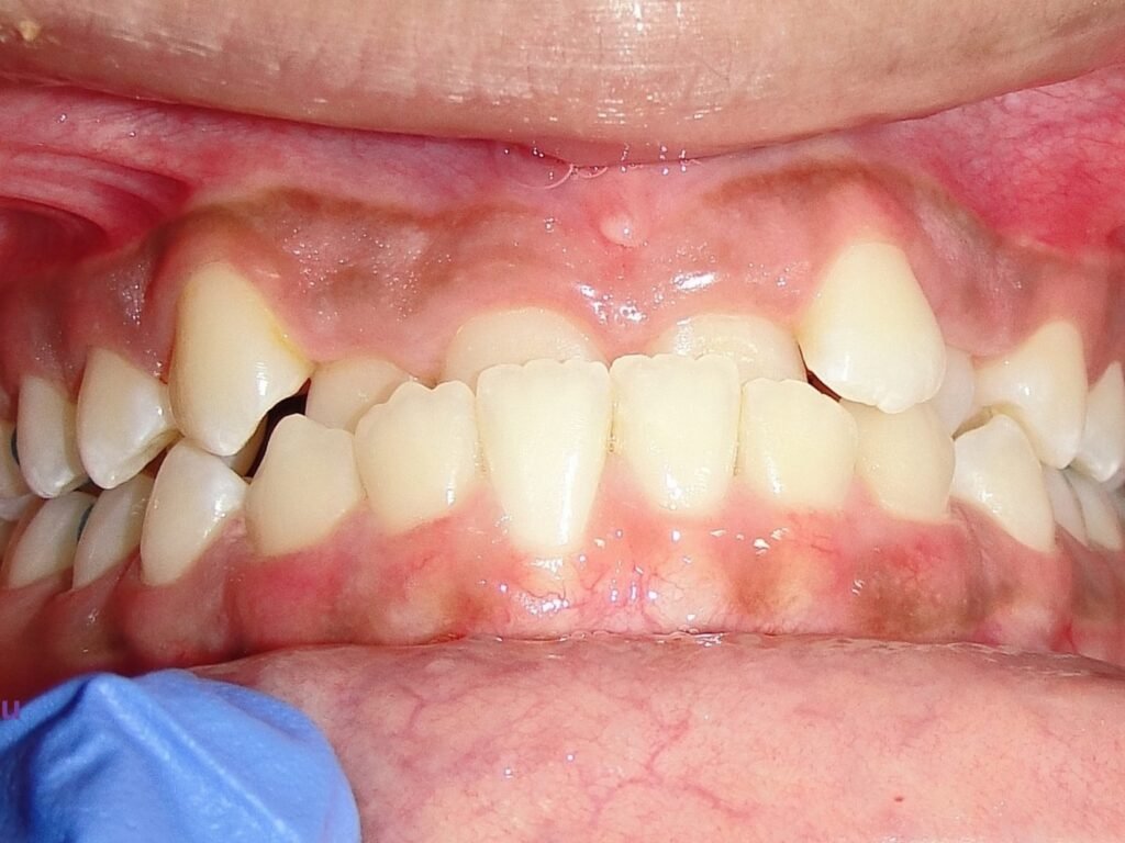 crossbite correction fixed braces — before 01, case 18 at Dr. Shouku Dental Clinic