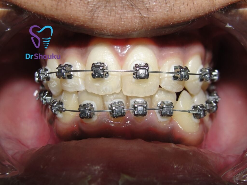 Later treatment stage with Damon Ultima self-ligating braces at Dr. Shouku Dental Clinic