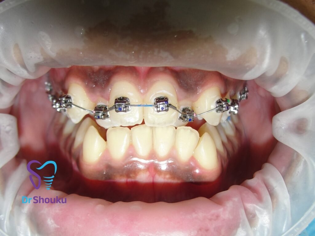 Earlier treatment stage with Damon Ultima self-ligating braces at Dr. Shouku Dental Clinic