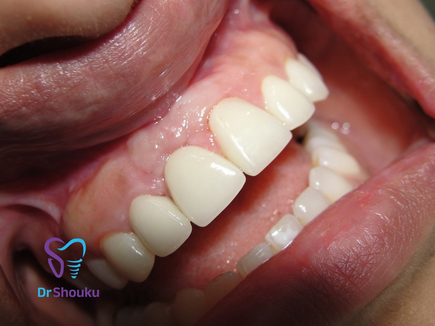 dental implant — after 01, case 1 at Dr. Shouku Dental Clinic