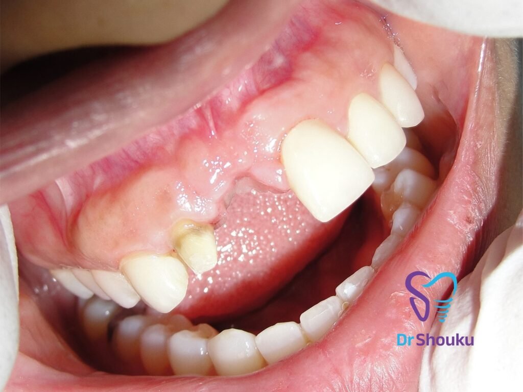 dental implant — before 01, case 1 at Dr. Shouku Dental Clinic
