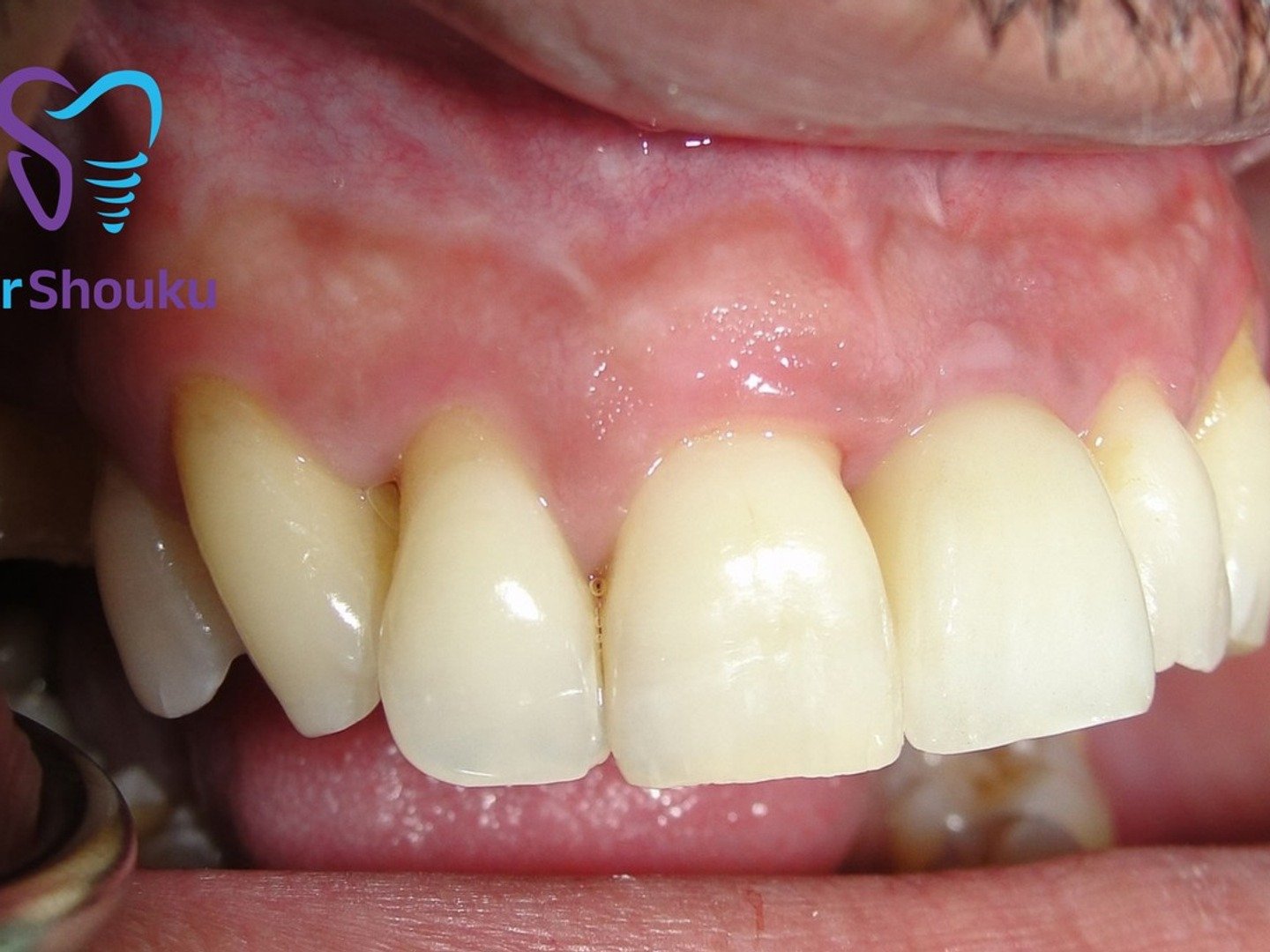 After dental implant treatment, case 02 at Dr. Shouku Dental Clinic
