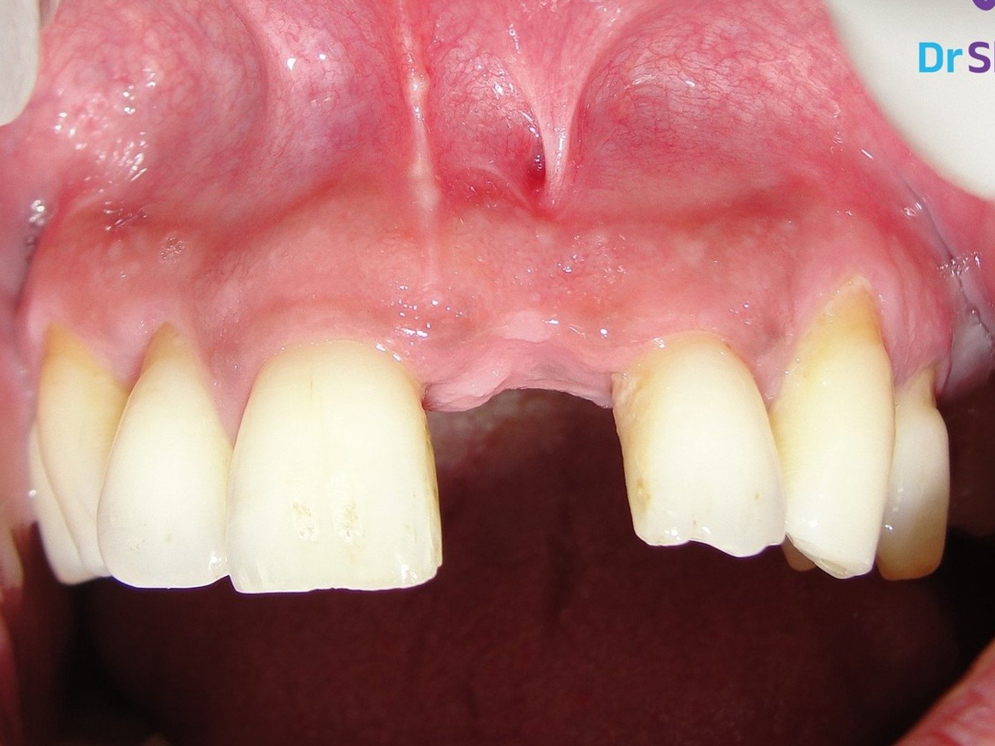 Before dental implant treatment, case 02 at Dr. Shouku Dental Clinic
