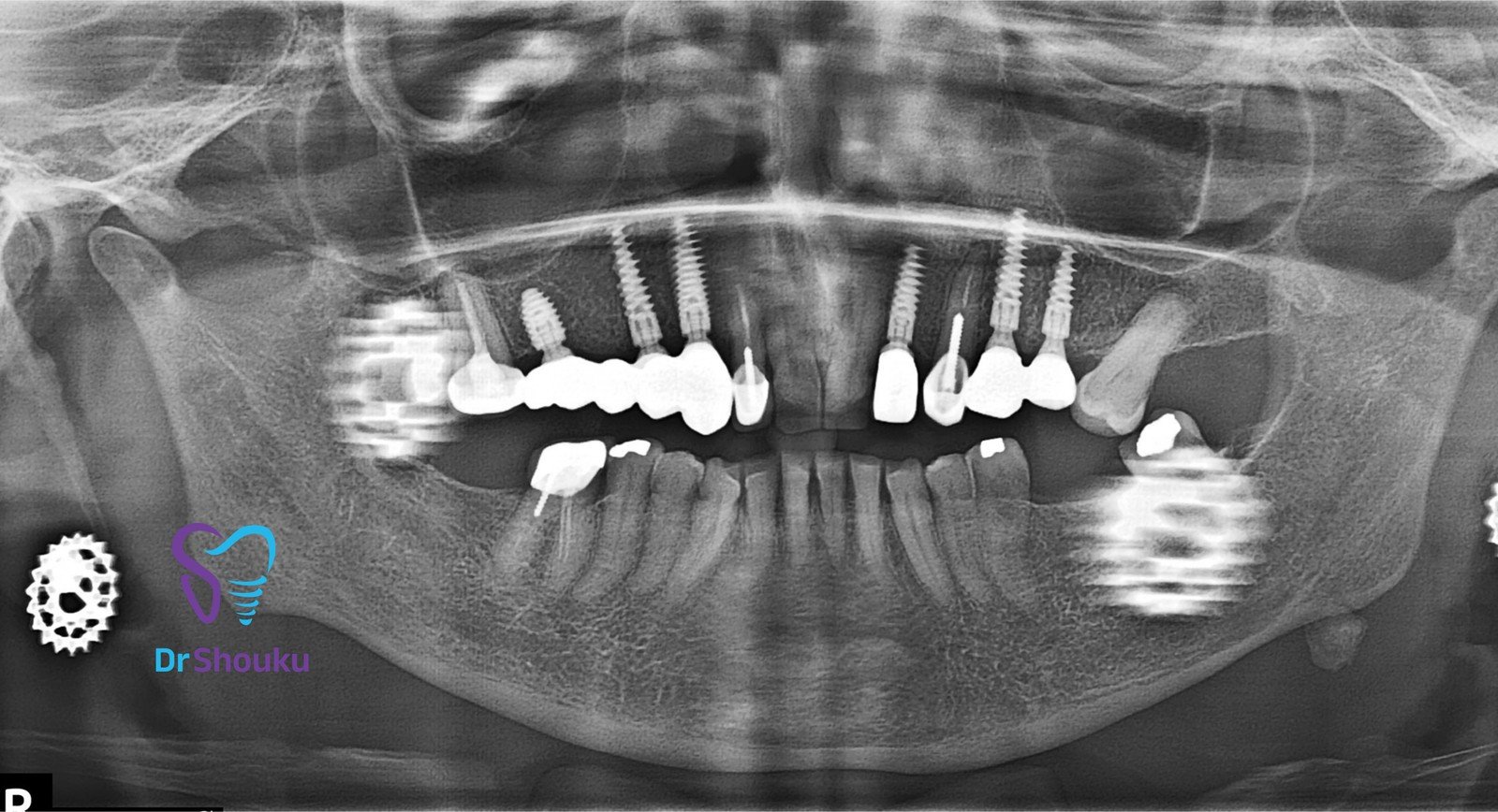 After implant treatment: case 88 X-ray at Dr. Shouku Dental Clinic