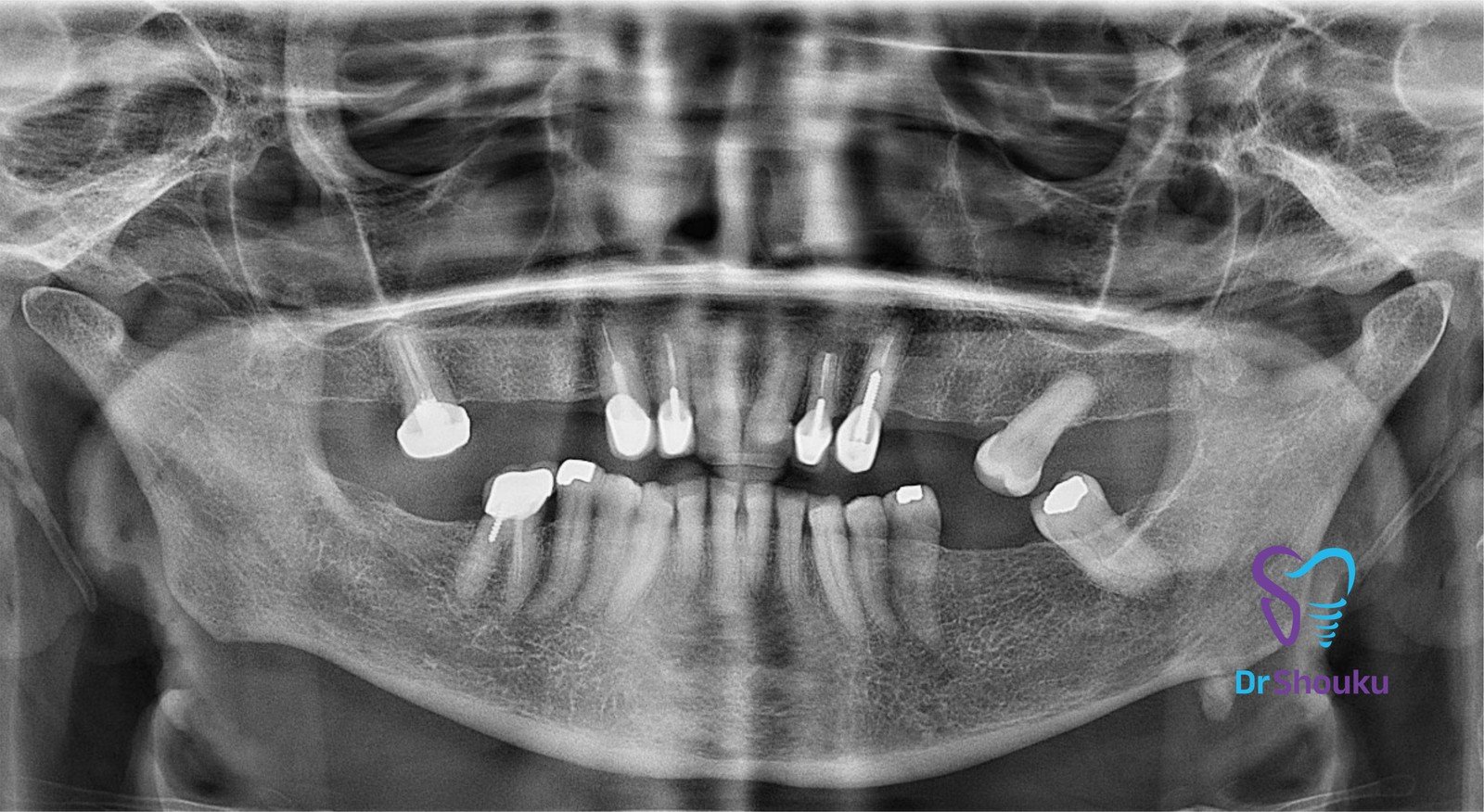 Before implant treatment: case 88 X-ray at Dr. Shouku Dental Clinic
