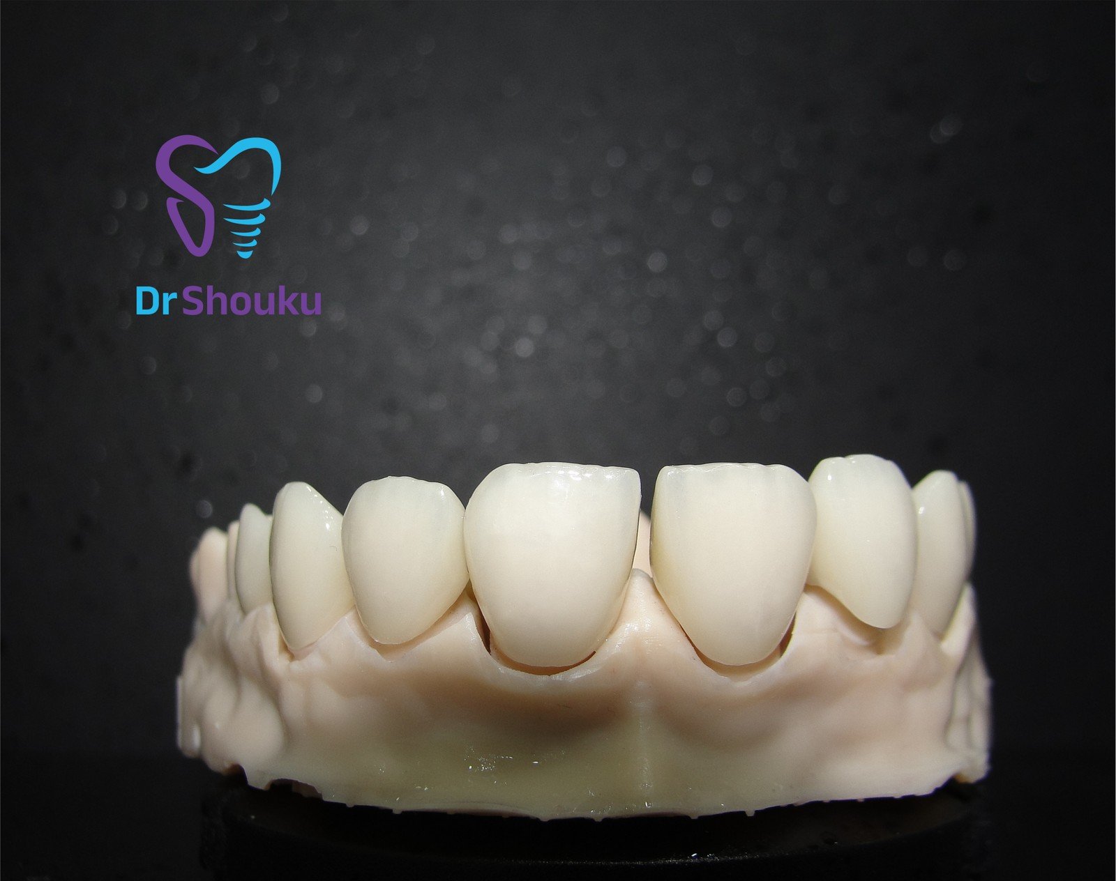 Dental veneers on a dental model at Dr. Shouku Dental Clinic