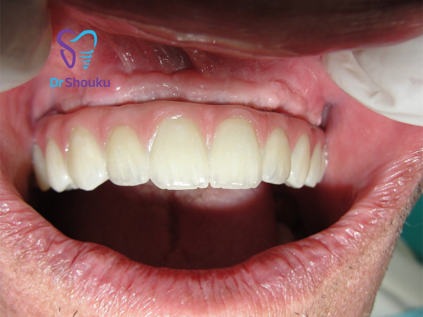 full mouth dental implants — after 02, case 100 at Dr. Shouku Dental Clinic
