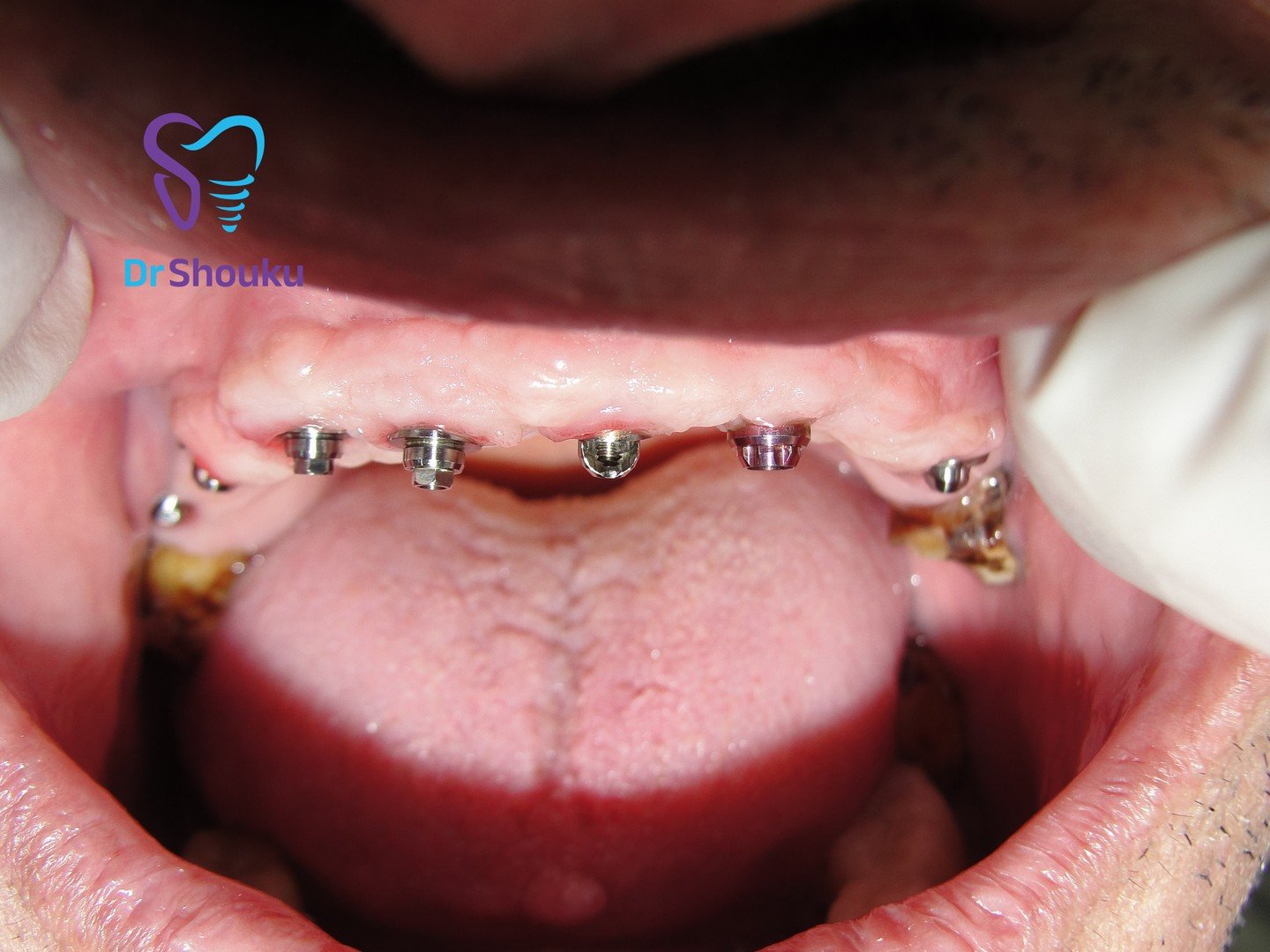 full mouth dental implants — before 02, case 100 at Dr. Shouku Dental Clinic