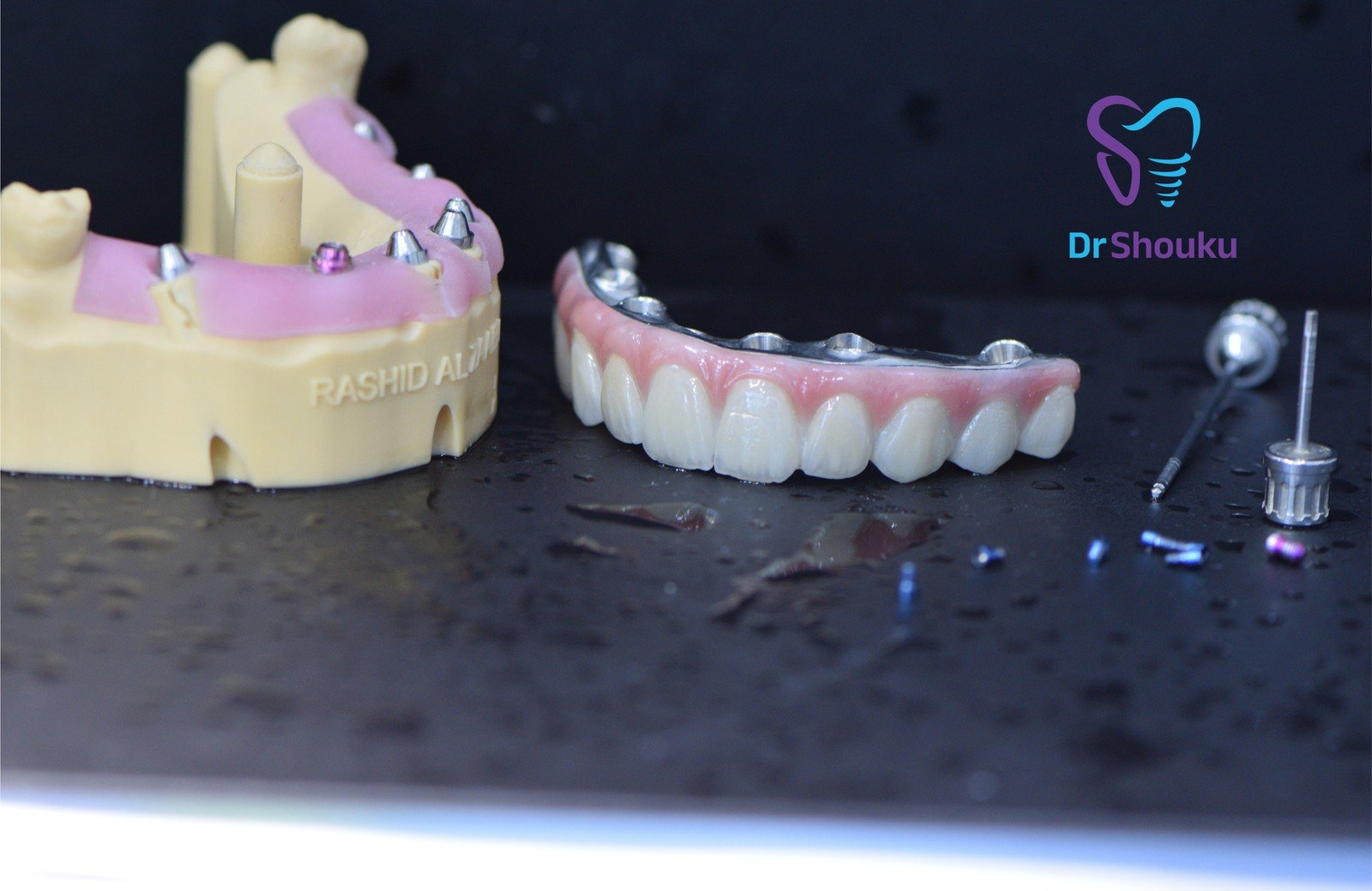 Full-mouth zirconia restoration with a titanium bar at Dr. Shouku Dental Clinic