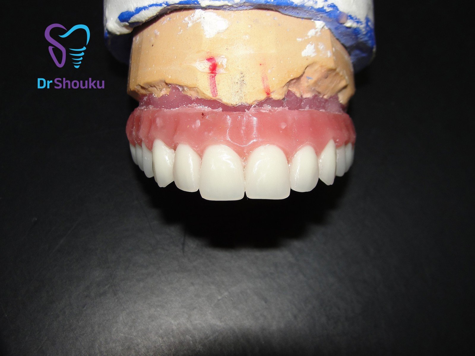 Trial wax-up for an implant denture on a dental model at Dr. Shouku Dental Clinic