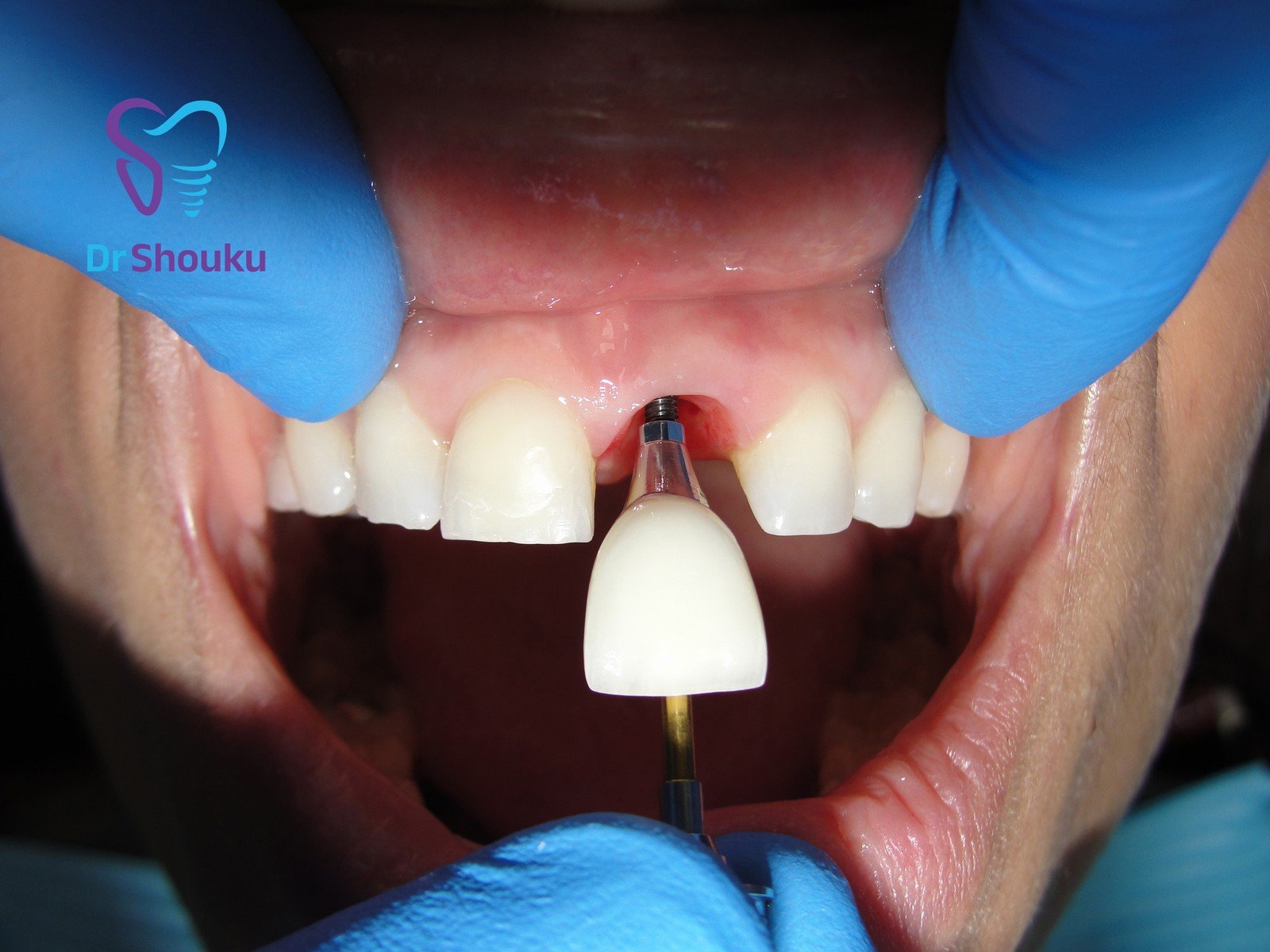Restoration fitting, frame A at Dr. Shouku Dental Clinic