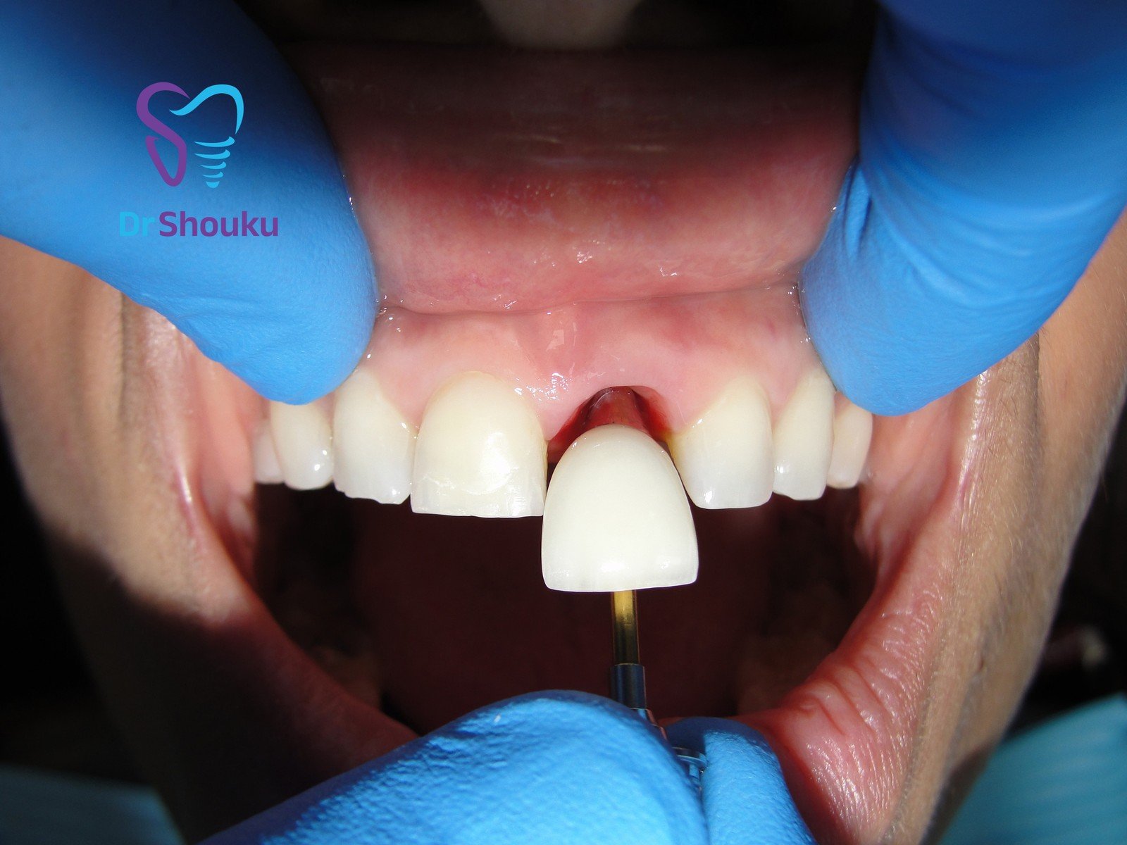 Restoration fitting, frame B at Dr. Shouku Dental Clinic