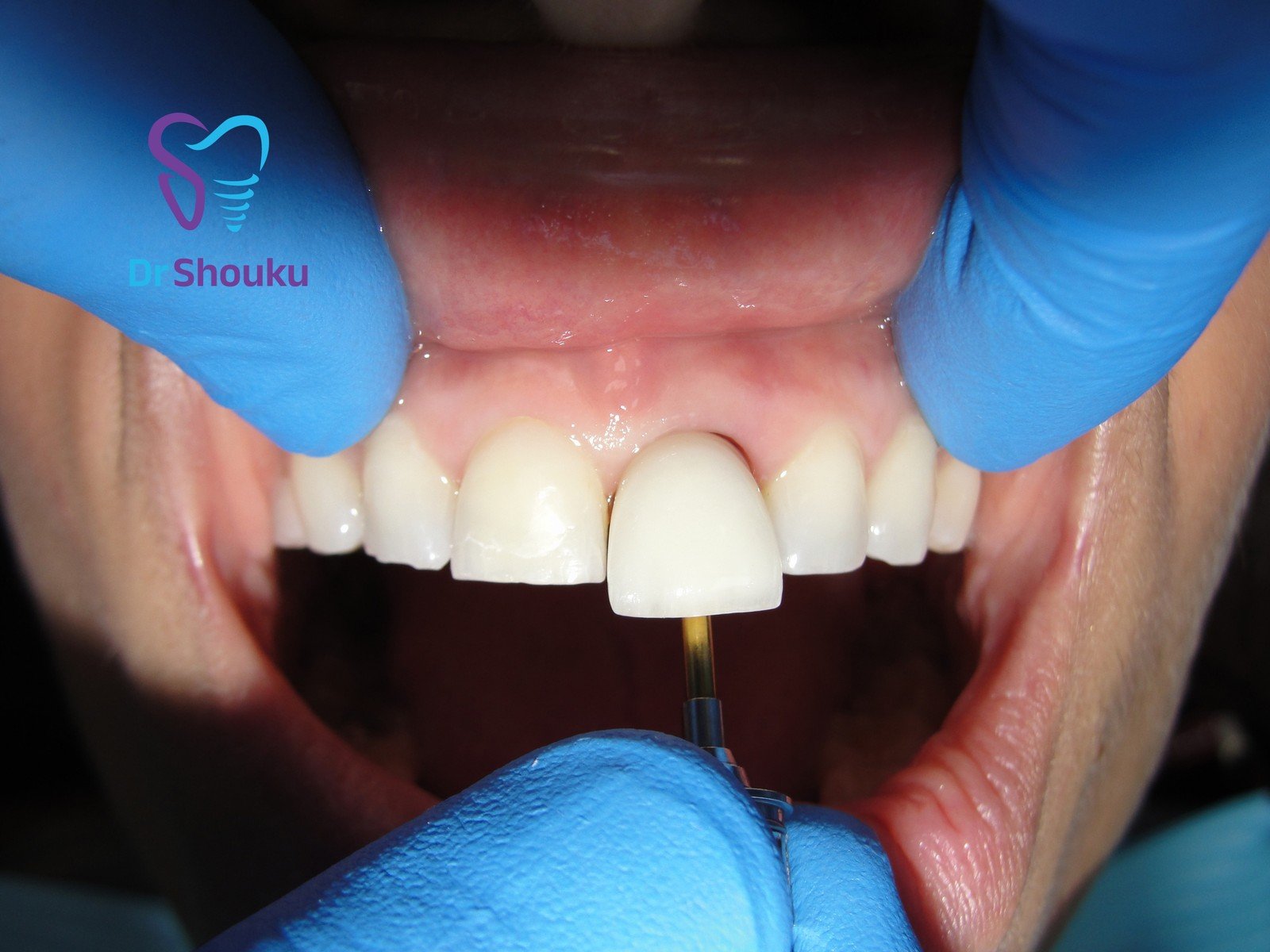 Restoration fitting, frame C at Dr. Shouku Dental Clinic