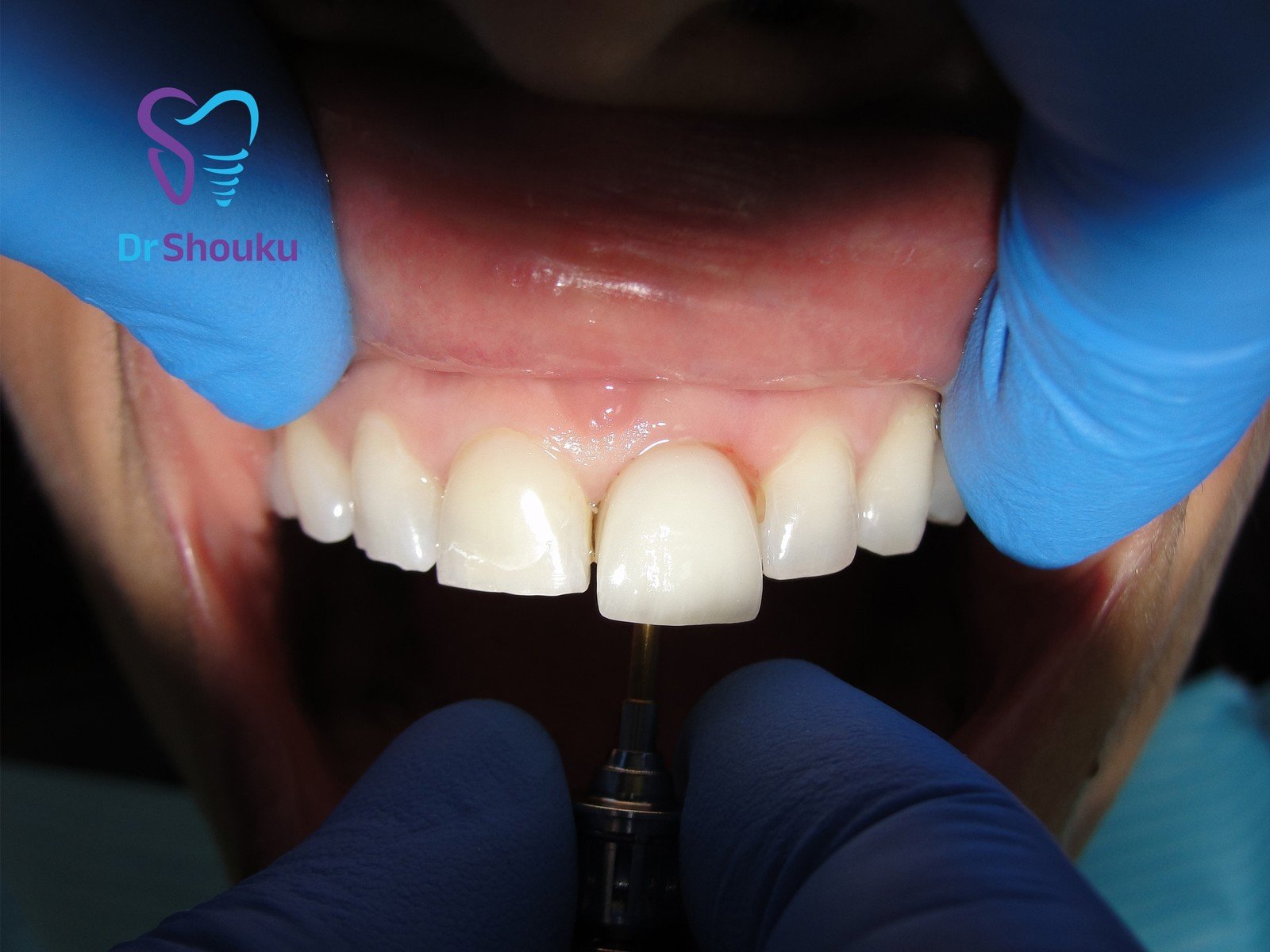 Restoration fitting, frame D at Dr. Shouku Dental Clinic