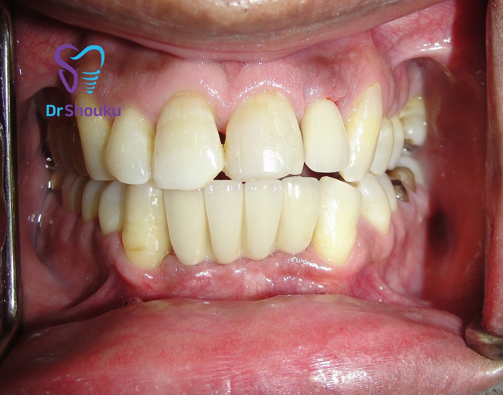 implant restoration stages — after 01, case 12 at Dr. Shouku Dental Clinic
