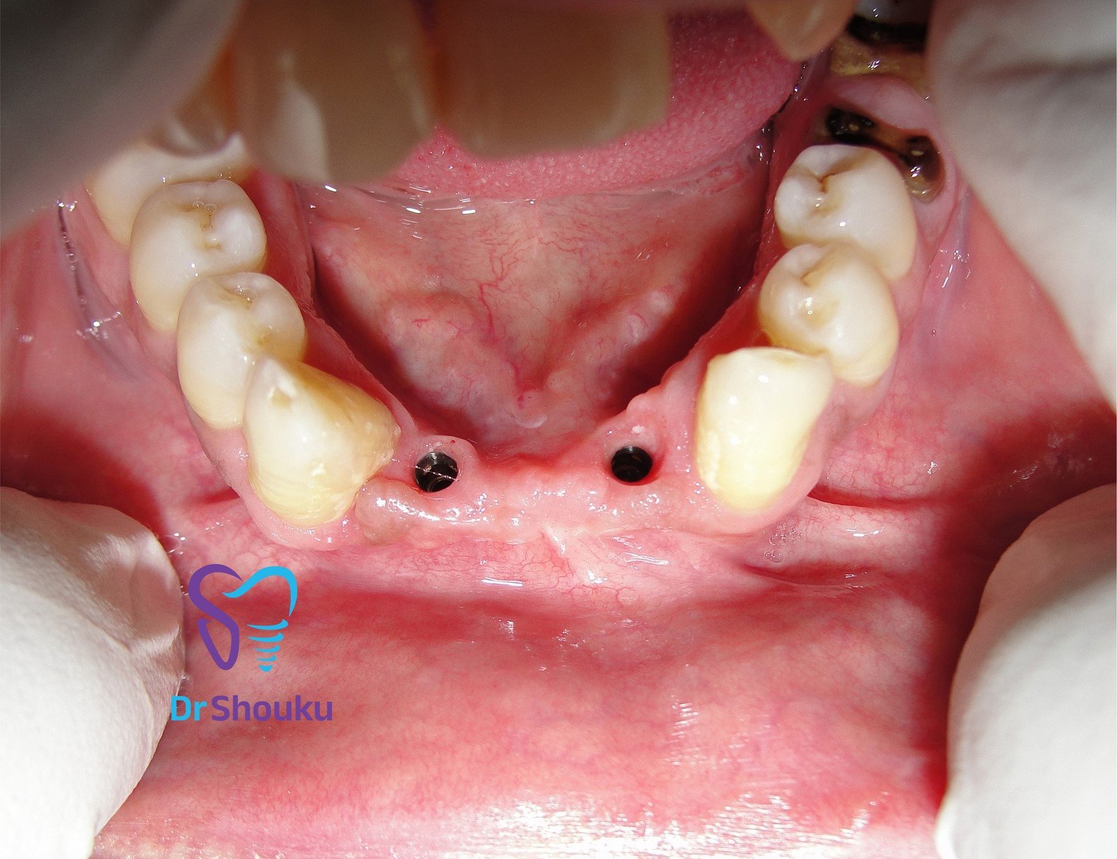 implant restoration stages — before 01, case 12 at Dr. Shouku Dental Clinic