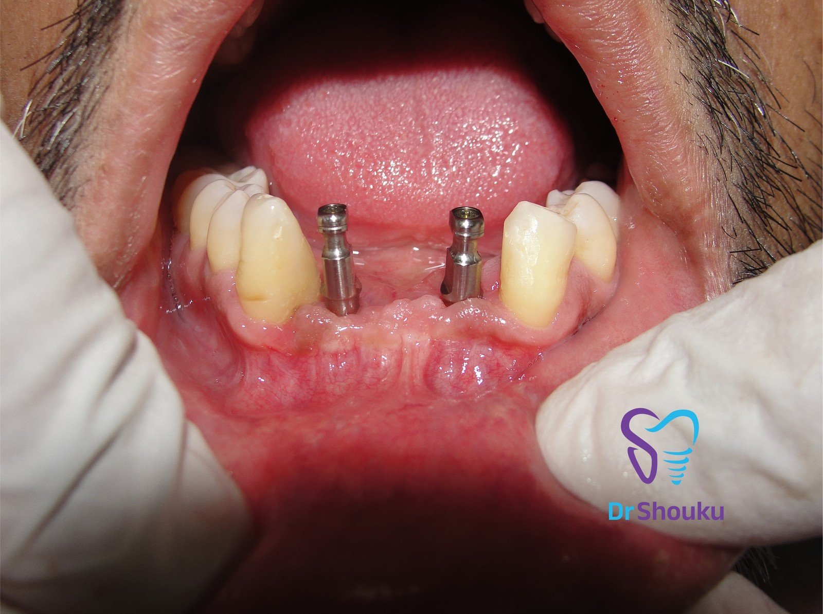 implant restoration stages — before 02, case 12 at Dr. Shouku Dental Clinic