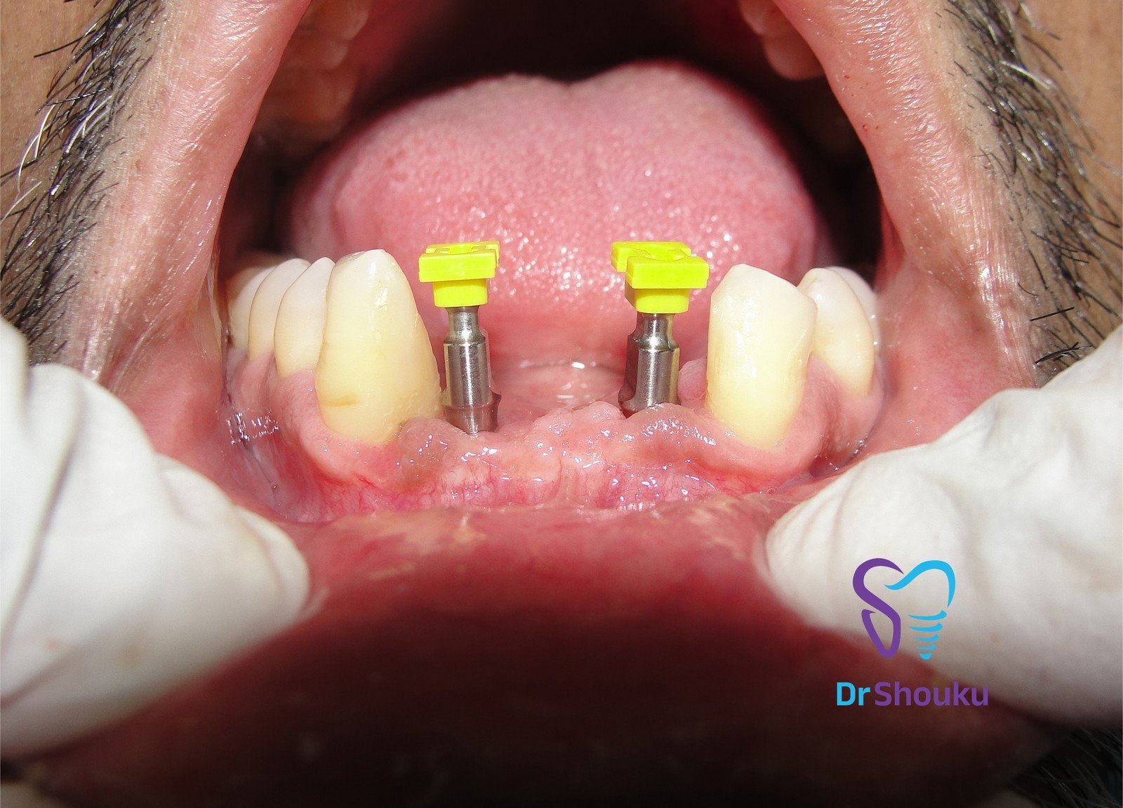 implant restoration stages — before 03, case 12 at Dr. Shouku Dental Clinic
