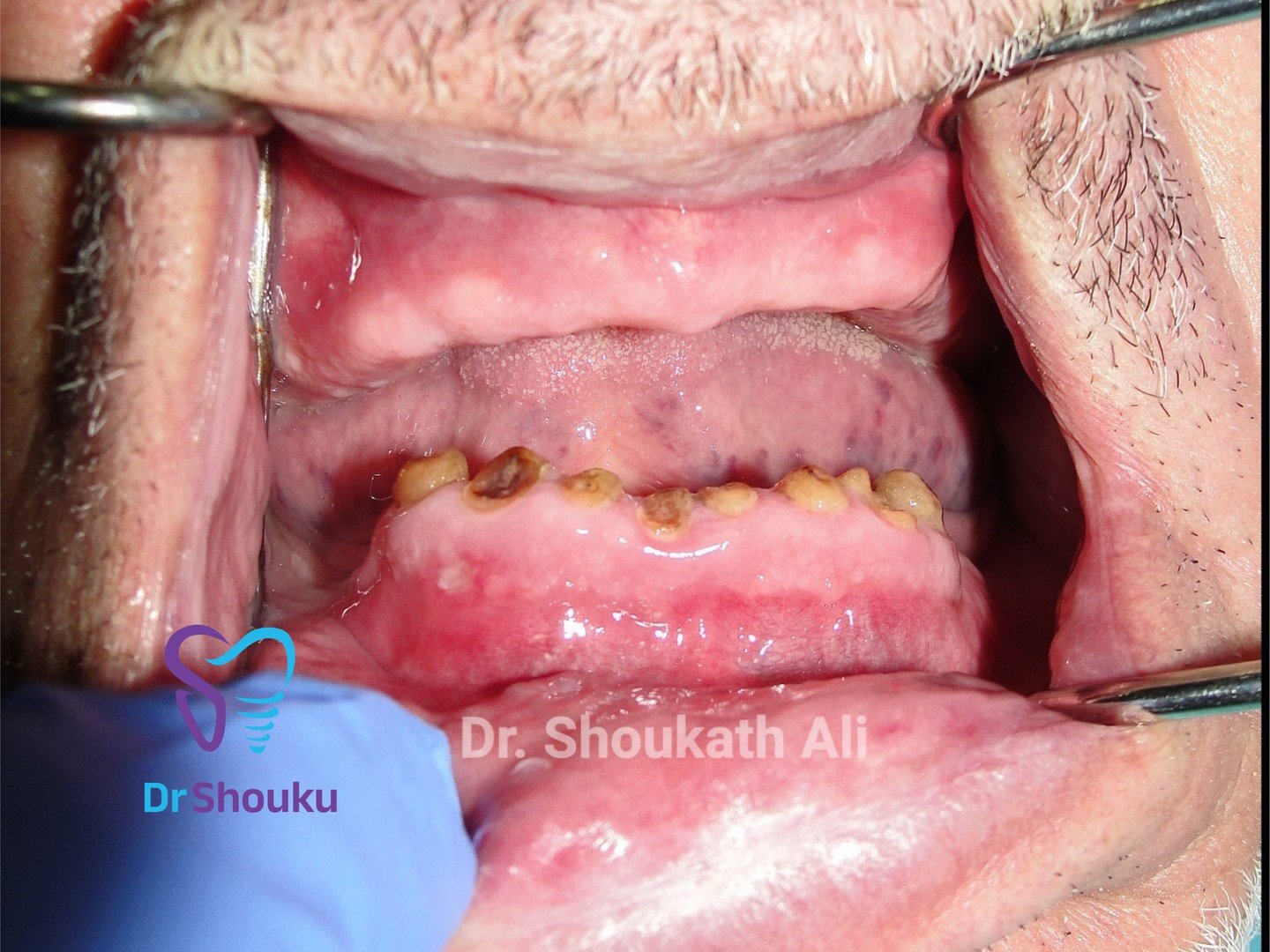 implant supported overdenture — view 02, case 78 at Dr. Shouku Dental Clinic