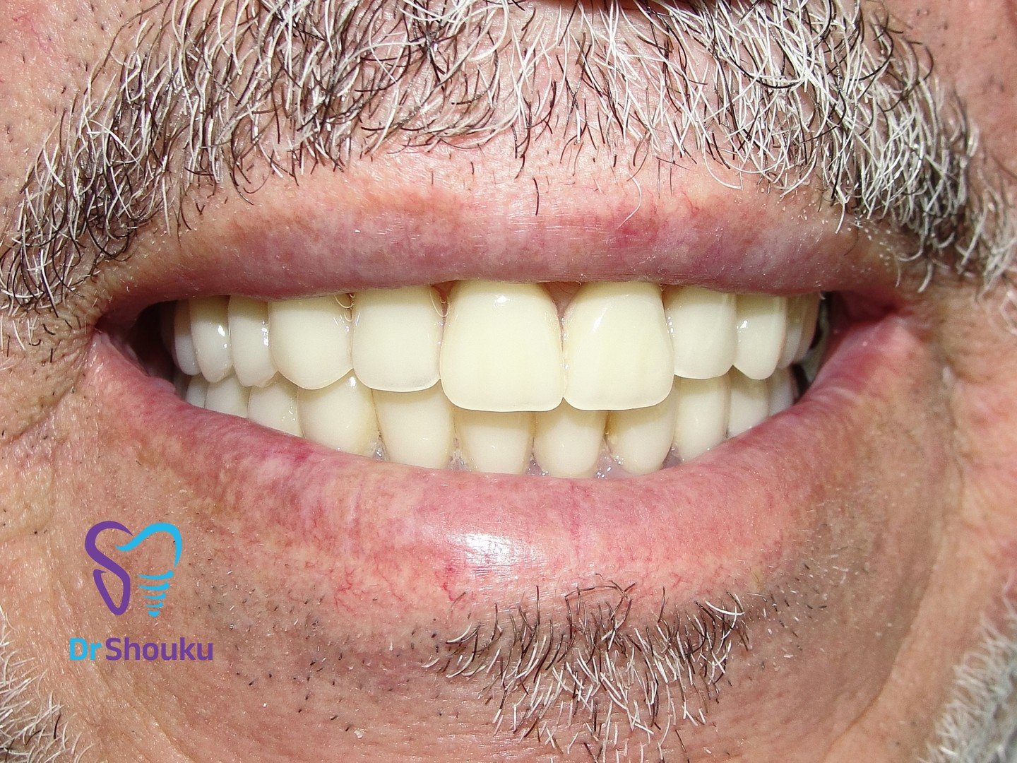 implant supported overdenture — view 03, case 78 at Dr. Shouku Dental Clinic