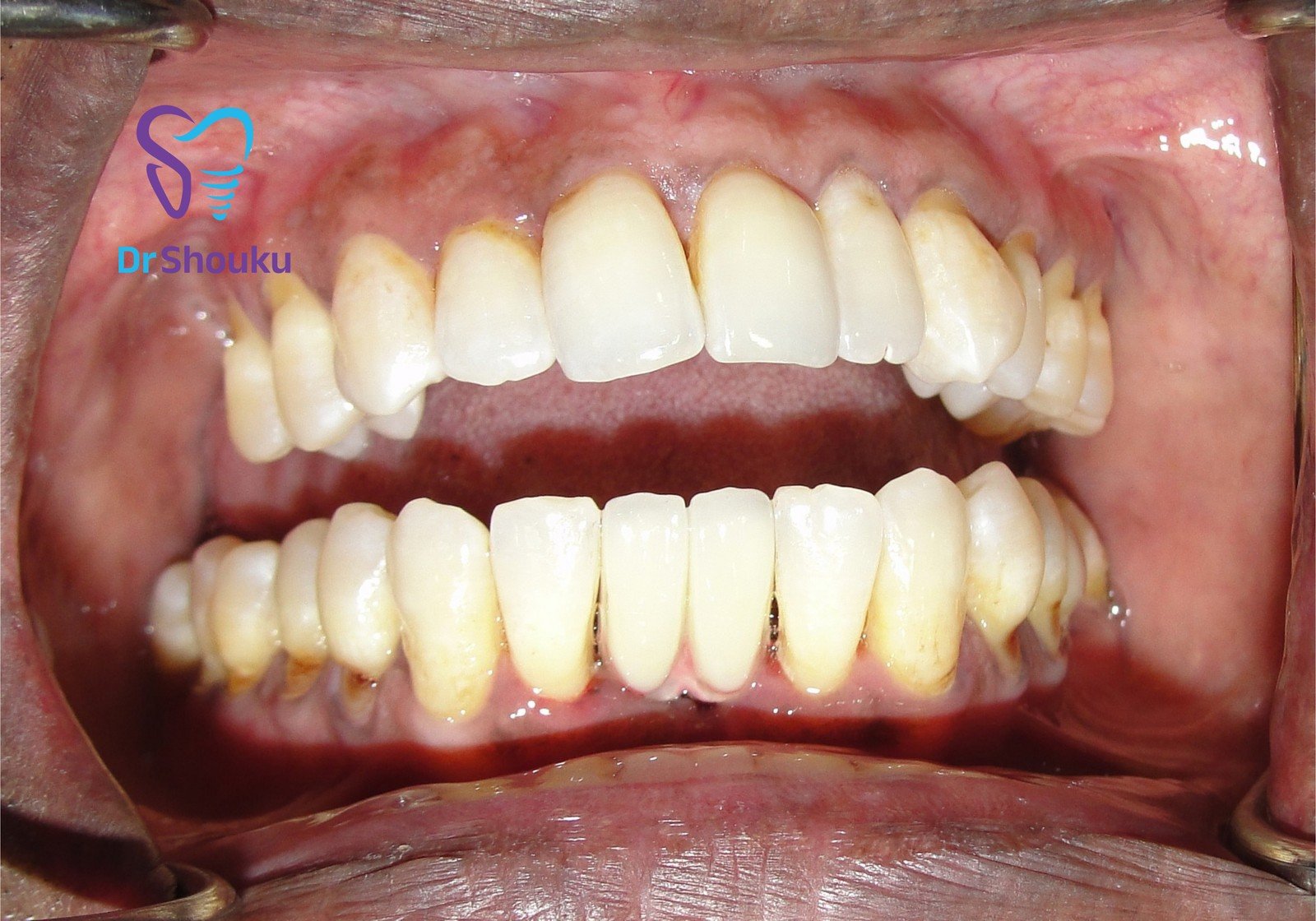implant treatment timeline — after 01, case 10 at Dr. Shouku Dental Clinic