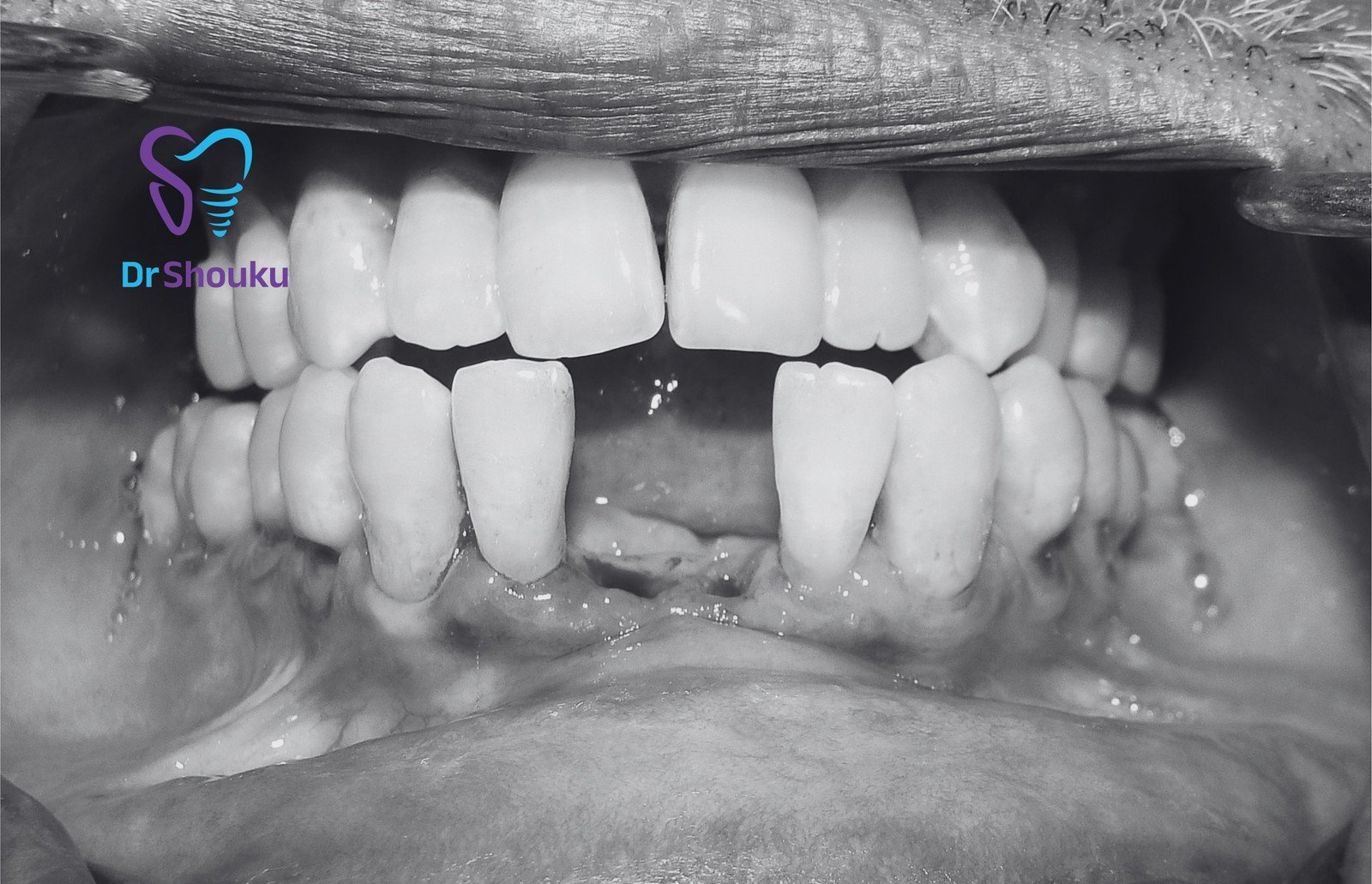 implant treatment timeline — before 01, case 10 at Dr. Shouku Dental Clinic