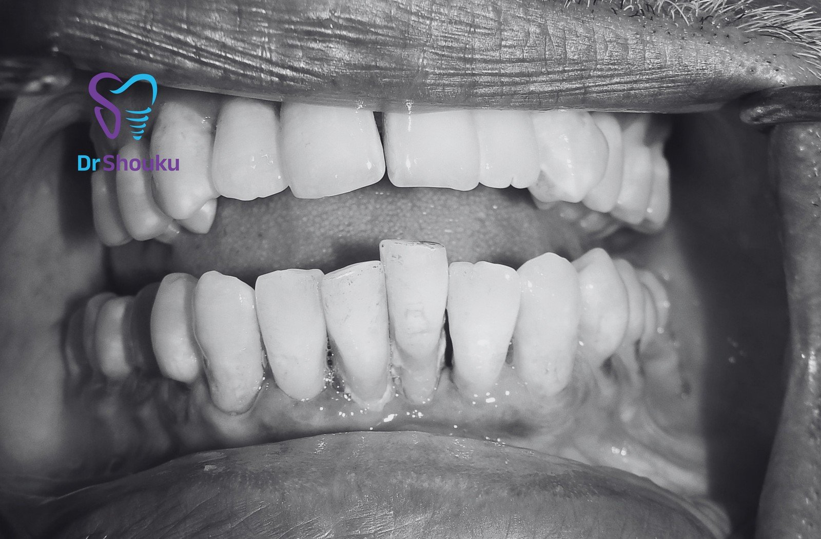 implant treatment timeline — before 02, case 10 at Dr. Shouku Dental Clinic