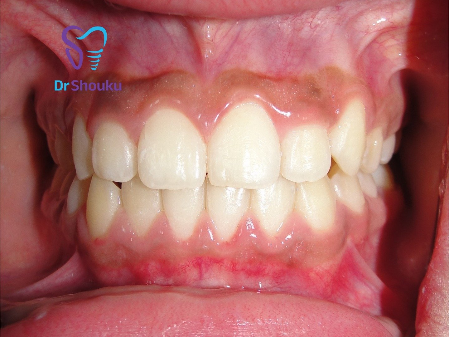 Teeth after Invisalign treatment, case 105 at Dr. Shouku Dental Clinic