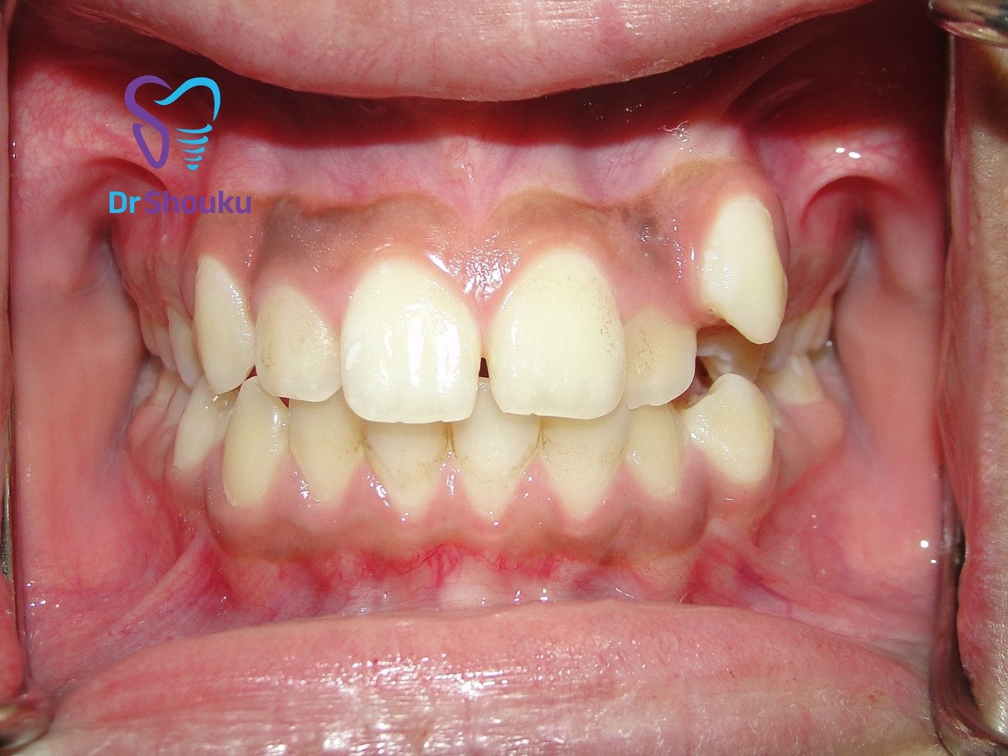 Teeth before Invisalign treatment, case 105 at Dr. Shouku Dental Clinic