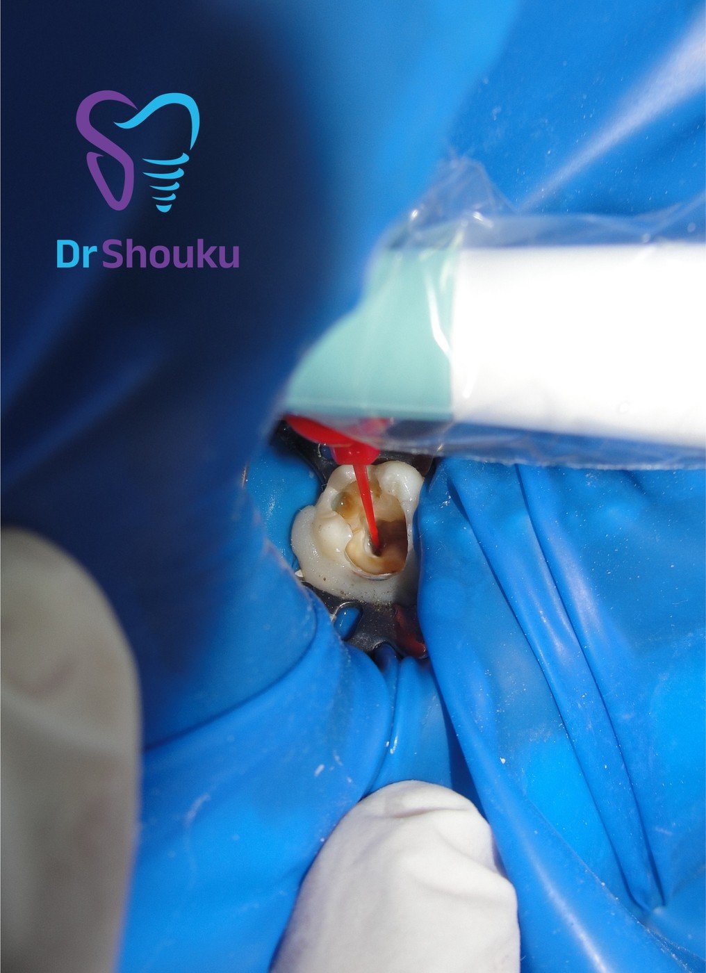 Close-up of treatment on an isolated tooth at Dr. Shouku Dental Clinic