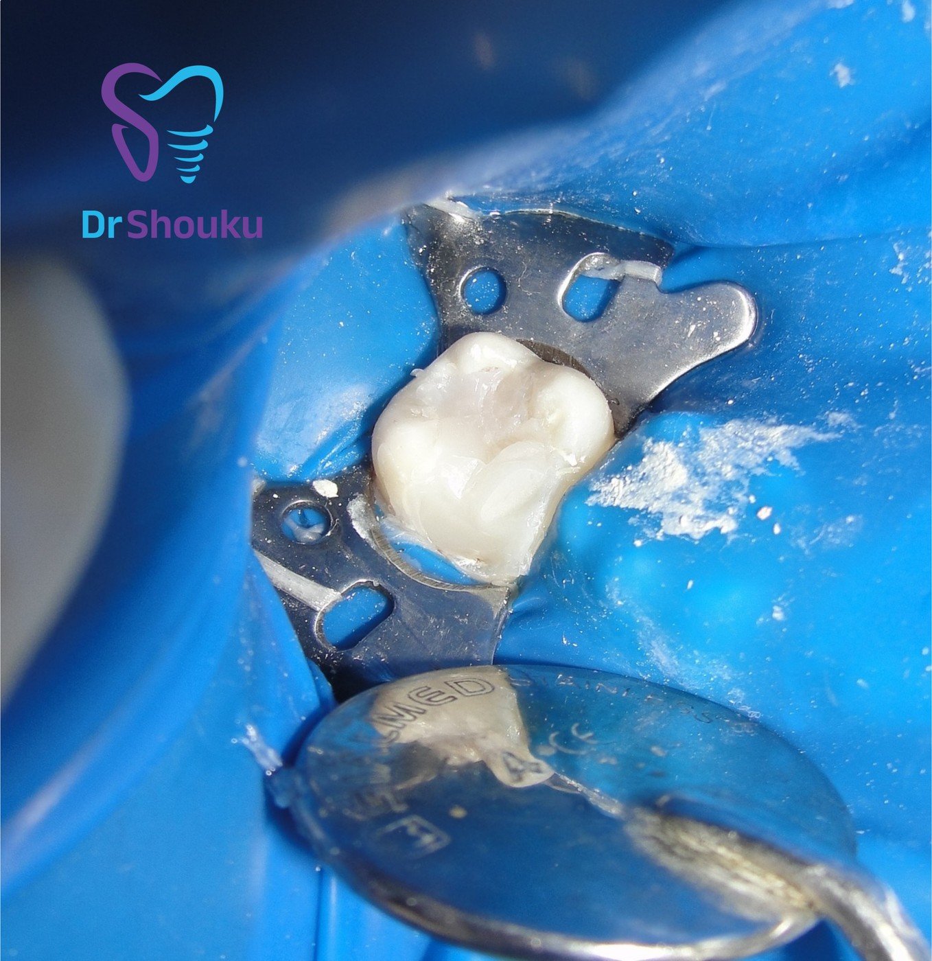 Root canal treatment with a rubber dam isolating the tooth at Dr. Shouku Dental Clinic